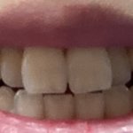 [댓글부탁해] <b>덧니</b> 어때??