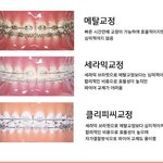 [드루와] 치아교정 <b>메탈</b>할까 세라믹할까