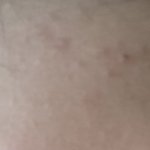[댓글부탁해] 나 여드름 <b>연고</b> 추천좀ㅠ