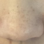 [꼭조언부탁] 나 블랙<b>헤드</b> 진짜로 심한편인데 관리하는법좀ㅜ
