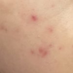 [드루와] <b>이정도</b> 여드름ㅠㅠㅠ(급급