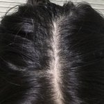 [조언부탁해] <b>탈모</b> 많이 심각하냐(혐)