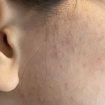 <b>턱</b><b>선</b>에 여드름 다 짜야함?사진주의