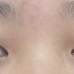 [드루와] 어제 쌍수한 후기