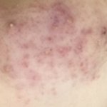[19] 혐주의) 이런 여드름 어케 없애??ㅠ