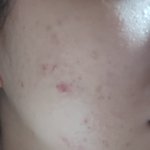 볼 여드름 어떻게 없애나요?(사진있음 혐주의)