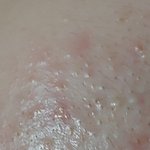 여드름있는 애드라 <b>드러</b>와바ㅜㅠㅠㅍ