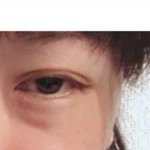[뷰티] 쌍수 망한거 특징 .jpg