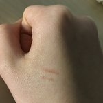 이거 <b>화상</b>흉터 쭉 갈것같음???