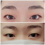 나 쌍수 할까 말까...