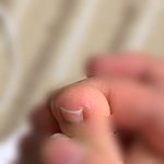 [댓글부탁해] (발가락주의) 이거 내성<b>발톱</b>이야..??