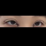 어제 쌍수<b>매몰</b>했는데 ㅠ 봐줘