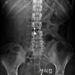 [댓글부탁] 생리컵 X<b>레이</b> 사진