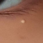 눈 밑 <b>요철</b> 없애는법좀..