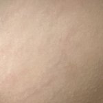 [댓글부탁해] 튼살 쓰니인데 이정도 <b>복구</b> ㄱㄴ?