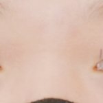 쌍수 3일차 어때 붓기 더 빠지겠지?