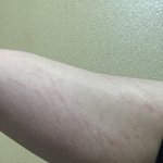 내튼살 <b>개심</b>한데 튼살크림이렁 없애는 방법 추천좀 해줘ㅜㅜㅜ