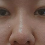 쌍수 2달차! <b>대만족</b>중 ㅎ