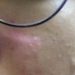 고1인데 피부때문에 너무스트레스받아..ㅠ(사진있음 혐주의)