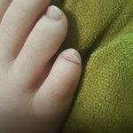 (<b>발톱</b>사진있음)헐 <b>발톱</b>이 덜렁덜렁거려