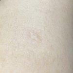 [댓글부탁해] 다들 <b>예방주사</b> 자국 남아있음??