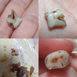 유명밥버거 소불고기에서 나온 <b>이물질</b> (뭐로 보이시나요? 혐오 주의)