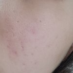 [댓글부탁해] 얘들아 나 피부 많이 더러워..?