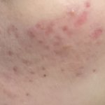 나 <b>피부</b> 많이 심각함...?? <b>사진</b><b>주의</b>