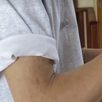 [NCT즌] 쥐송이도 아토피있나?