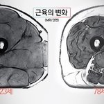 20대와 70대의 허벅지 단면