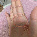 [드루와] 나 손바닥이 부었는데 뭐지 왜 부었지