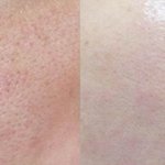 [드루와] 피부 모공 줄이는법 푼다