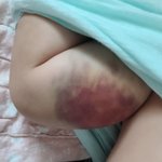 [긴급] 혈우병 아이들이 학대받고 있습니다.