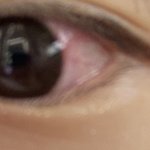[댓글부탁해] 눈이 <b>충혈</b>됐는데