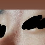 [댓글부탁해] 피부 ㅈㄴ혐스러운데ㅜ어카노..ㅈㅂ