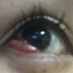 뒷트임 <b>밑</b>트임 후 부작용(<b>사진</b>혐오주의)