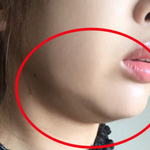 [마약] 보름달턱 없애는 방법