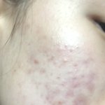 [댓글부탁해] 피부 조언좀ㅠㅠ [혐주의]