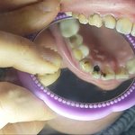 쪽팔리지만 지금 내 <b>윗니</b> 안쪽이 이렇다.