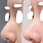 [드루와] <b>코</b>수술 <b>코끝</b>내려옴 심하냐..