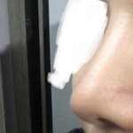 [댓글부탁해] <b>무보형물</b> 코수술햇는데 재수술할겅데 머할가