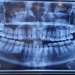 사랑니 뺀 후기