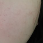 [댓글부탁해] 볼에 <b>블렉헤드</b> 같은거 어떡해야돼?