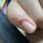 큐티클 정리하는데 유혈<b>사태</b> 쒯