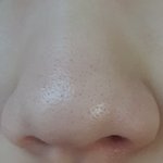 [이것좀봐줘] 블렉헤드 없애는 방법좀ㅠ 비<b>위약</b>하신분 넘겨주세요
