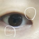 [댓글부탁해] 비립종 피부과 <b>가야</b> 사라짐??