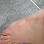 절대 피부묘<b>기증</b>은 걸리지마라...
