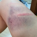 [댓글부탁해] 오늘 <b>상처</b> 봤는데