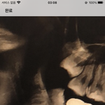 내 사랑니 보고 갈래?