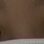 나 쌍수 재수술이고 부분절개하고 병원 나오면서 찍은건데
